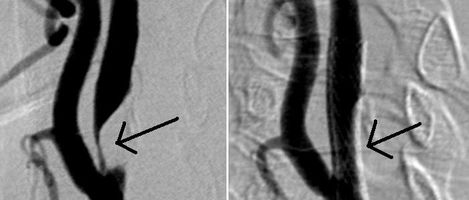 Hochgradige Engstellung (Stenose) der Halsschlagader vor (links) und nach (rechts) Angioplastie und Stentanlage.