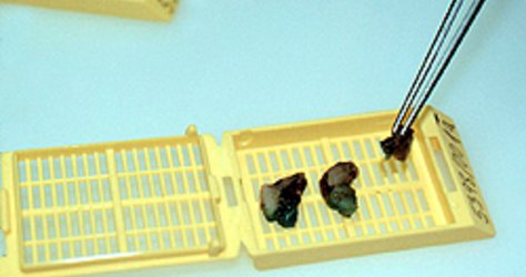 Gewebeproben werden nach Formalinfixierung in verschließbare Einbettkassetten gegeben. Gewebeproben werden nach Formalinfixierung in verschließbare Einbettkassetten gegeben.