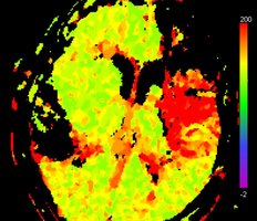 Durchblutungsmessung des Gehirns mittels Computertomographie