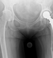 Patientin mit Lockerung einer zementierten Hüftprothese