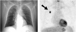 Links ist ein digitales Röntgenbild eines Brustkorbs zu sehen. Rechts ist ein PET-Bild des gleichen Brustkorbs, in dem ein Tumor zu erkennen ist (Pfeil).