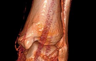 Hochauflösende Darstellung der Unterschenkelgefäße mittels Mehrzeilen CT 