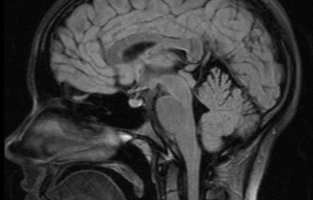 MRT eines Schädels. Ein sehr wertvolles Verfahren zur Diagnostik von Erkrankungen des Gehirns.
