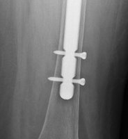 Patientin mit Lockerung einer zementierten Hüftprothese