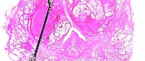 Großschnitt durch eine Prostata mit projezierter Biopsienadel. Großschnitt durch eine Prostata mit projezierter Biopsienadel.