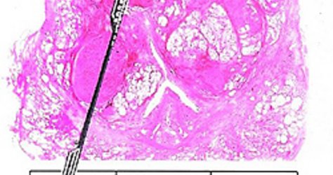 Großschnitt durch eine Prostata mit projezierter Biopsienadel. Großschnitt durch eine Prostata mit projezierter Biopsienadel.