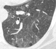 Hochauflösende CT des Lungengewebes oder -gerüstes. Solche Untersuchungen spielen eine wichtige Rolle bei der Diagnostik von Lungengerüst- erkrankungen (Fibrosen).