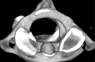 Dreidimensionale Berechnung und Abbildung eines Halswirbelkörpers.