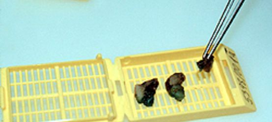 Gewebeproben werden nach Formalinfixierung in verschließbare Einbettkassetten gegeben. Gewebeproben werden nach Formalinfixierung in verschließbare Einbettkassetten gegeben.