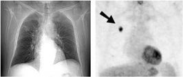 Links ist ein digitales Röntgenbild eines Brustkorbs zu sehen. Rechts ist ein PET-Bild des gleichen Brustkorbs, in dem ein Tumor zu erkennen ist (Pfeil).