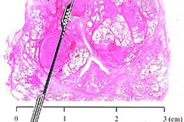 Großschnitt durch eine Prostata mit projezierter Biopsienadel. Großschnitt durch eine Prostata mit projezierter Biopsienadel.