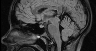 MRT eines Schädels. Ein sehr wertvolles Verfahren zur Diagnostik von Erkrankungen des Gehirns.