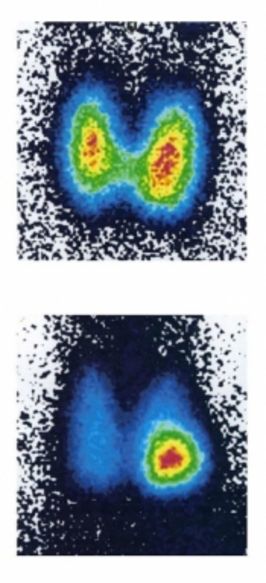 Szintigramm einer gesunden und erkrankten Schilddrüse.