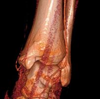 Hochauflösende Darstellung der Unterschenkelgefäße mittels Mehrzeilen CT