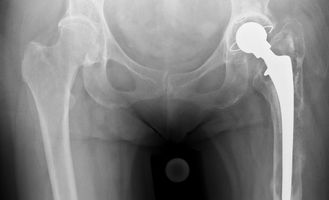 Patientin mit Lockerung einer zementierten Hüftprothese