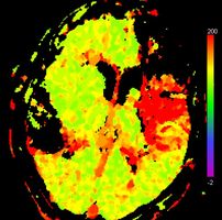 Durchblutungsmessung des Gehirns mittels Computertomographie