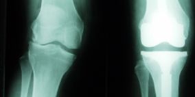 Röntgenaufnahme Knie