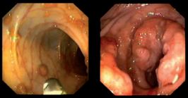 Übergang gutartiger Polyp in einen bösartigen Tumor (Karzinom)