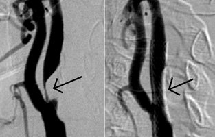 Hochgradige Engstellung (Stenose) der Halsschlagader vor (links) und nach (rechts) Angioplastie und Stentanlage.