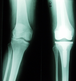 Röntgenaufnahme Knie