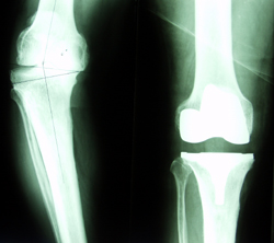 Röntgenaufnahme Kniegelenke